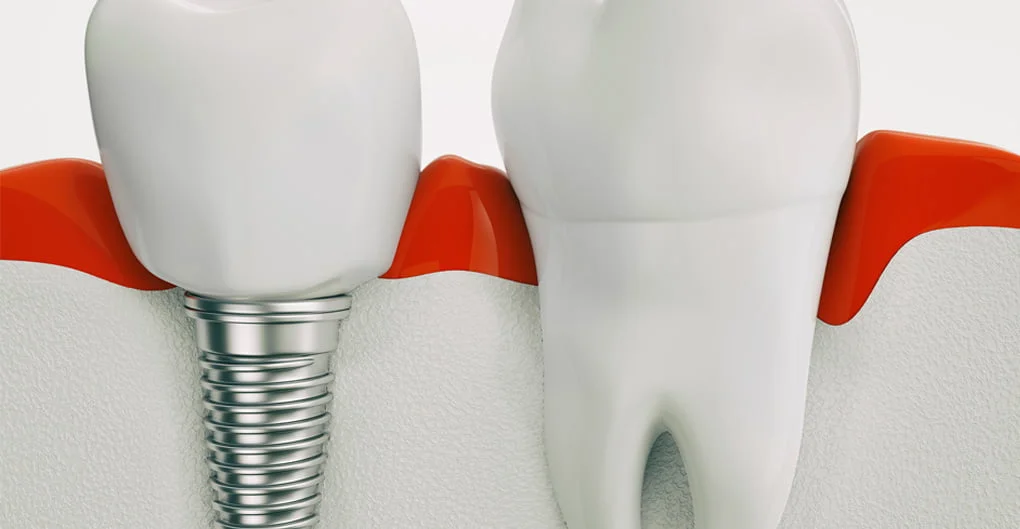 Les avantages de remplacer une dent par un implant dentaire