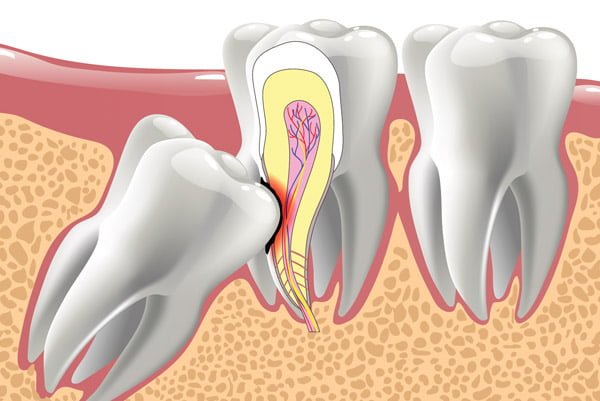 Extraction des dents de sagesse, Que sont les dents de sagesse