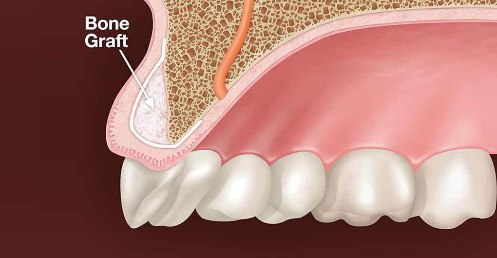 Why an Oral Surgeon May Recommend a Bone Graft Before Dental Implants?