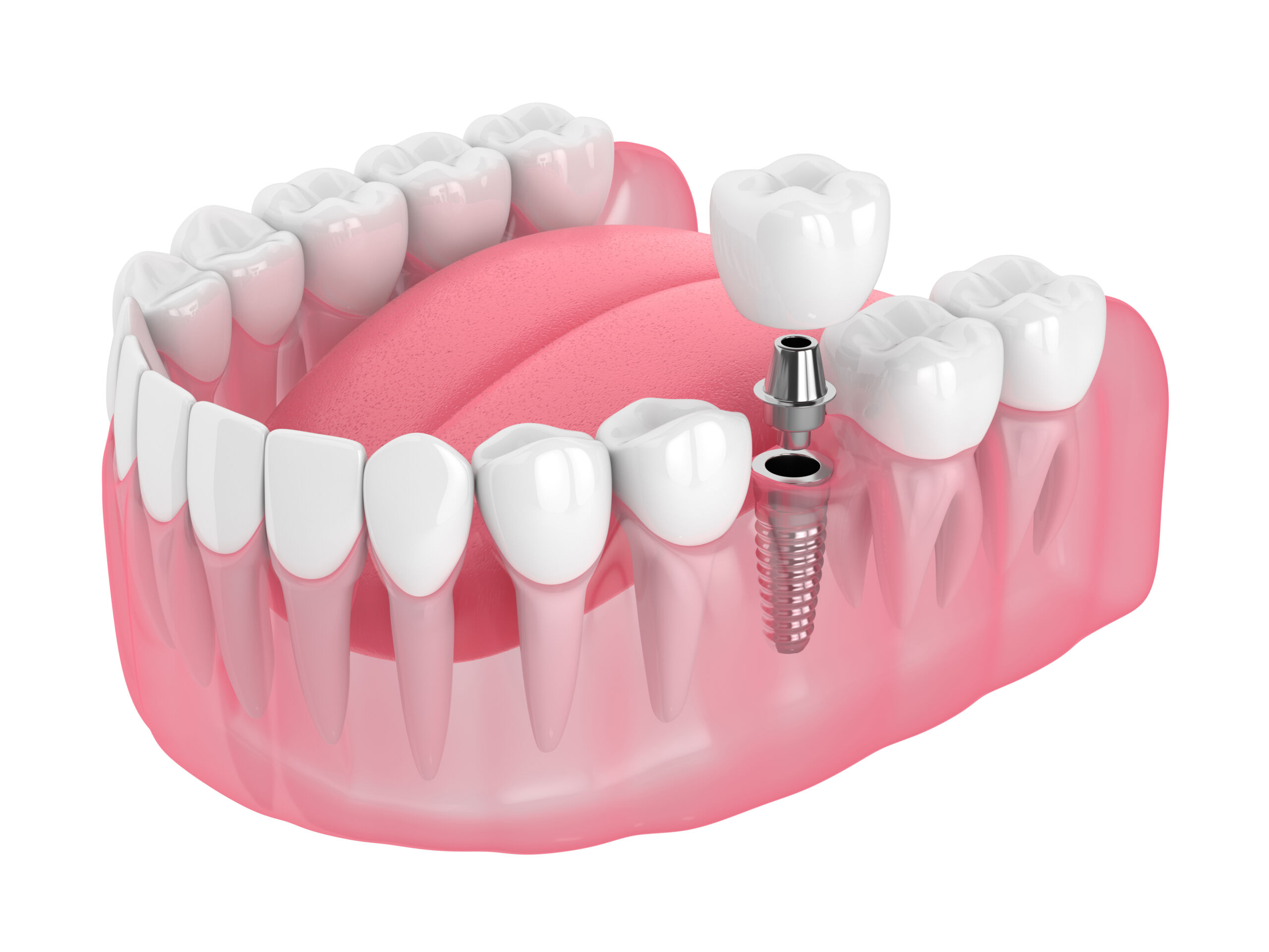 image of 3d render of jaw with dental implant isolated over white background