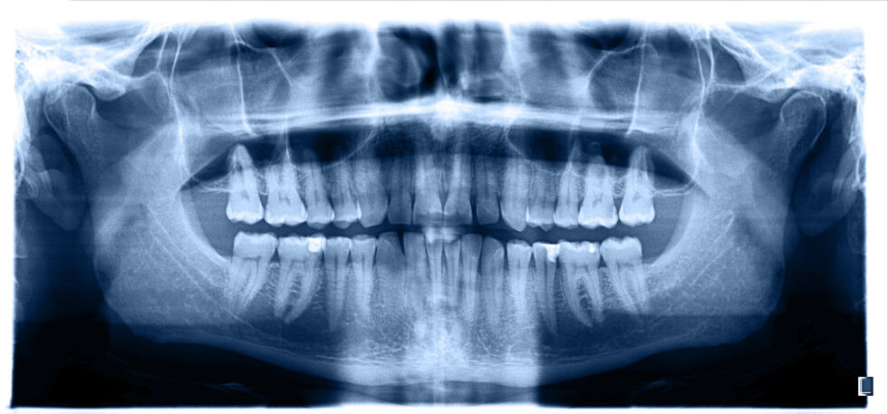 What Are Alloplastic Grafts | MaxilloVendome