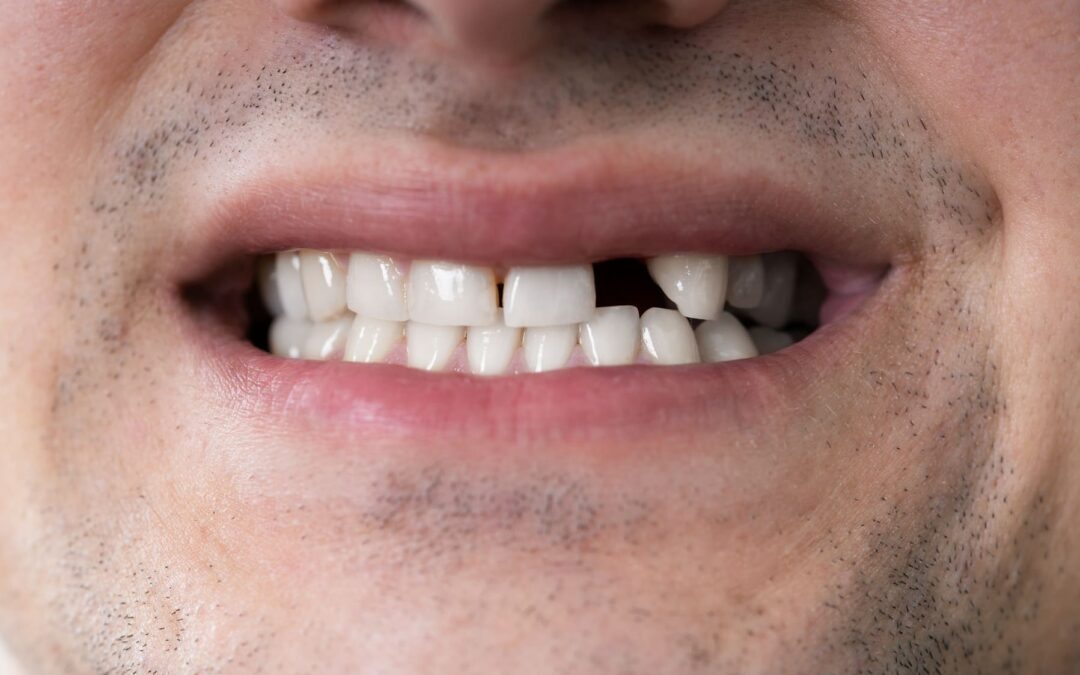 The Long-Term Benefits of Dental Implants: A Permanent Solution for Missing Teeth?